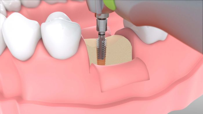 Фізіодиспенсер ImplantMED Si-1023